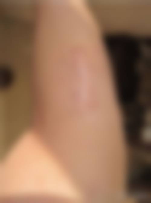 {唇裂手术后怎么护理可以减少疤痕？掌握这些要点，让疤痕淡化不再是难题！ 