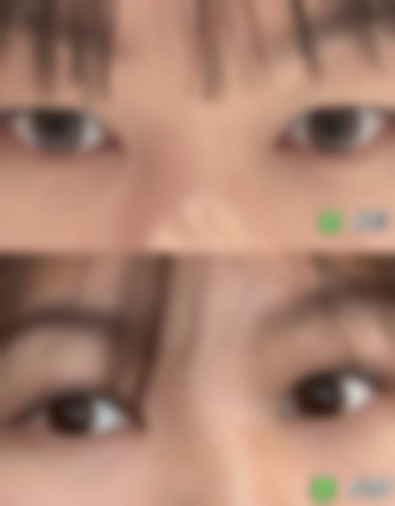 {眼尾上扬适合什么双眼皮？平行型或开扇形双眼皮或是不错之选 