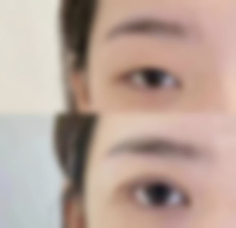 眼尾上扬做双眼皮后的护理