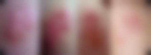 三、医生技术与疤痕愈合瘙痒的关系