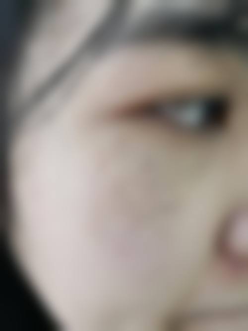 三、安徽医 科 大学第一附属医院点痣流程