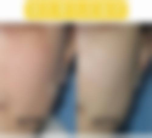 四、安徽医 科 大学第一附属医院点痣术后护理