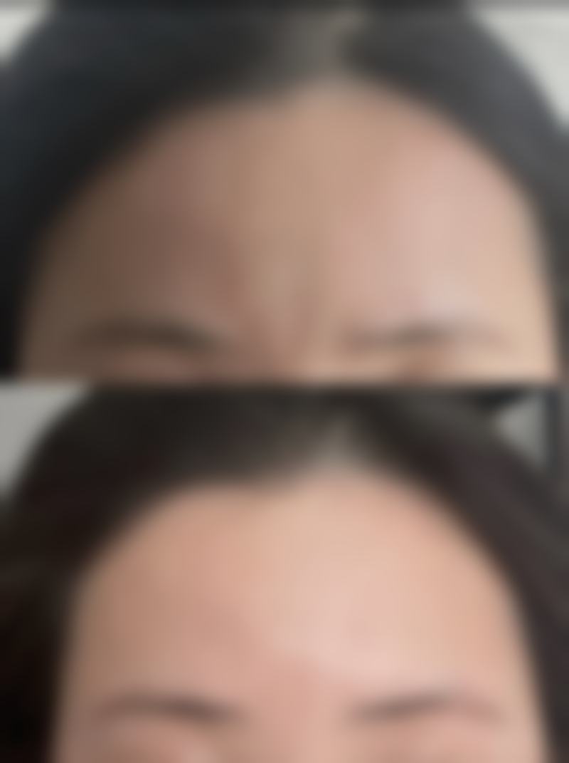 {打保妥适瘦脸针多少钱？一般2000元到6000元，受剂量、机构等因素影响