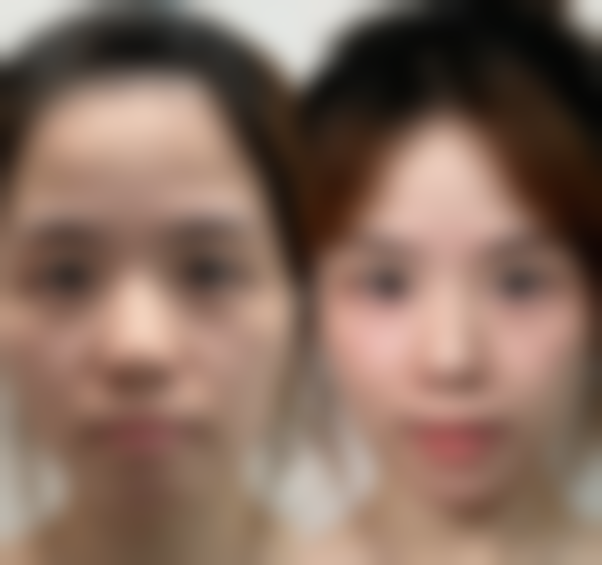 二、安徽医 科 大学第一附属医院点痣技术优势