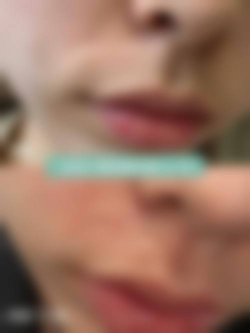 激光修复脸上疤痕