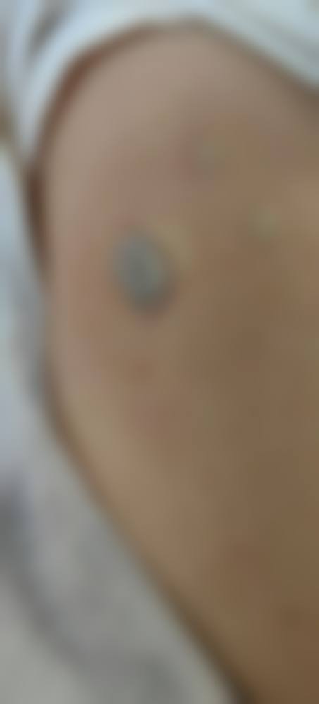 三、激光治疗的优势与注意事项