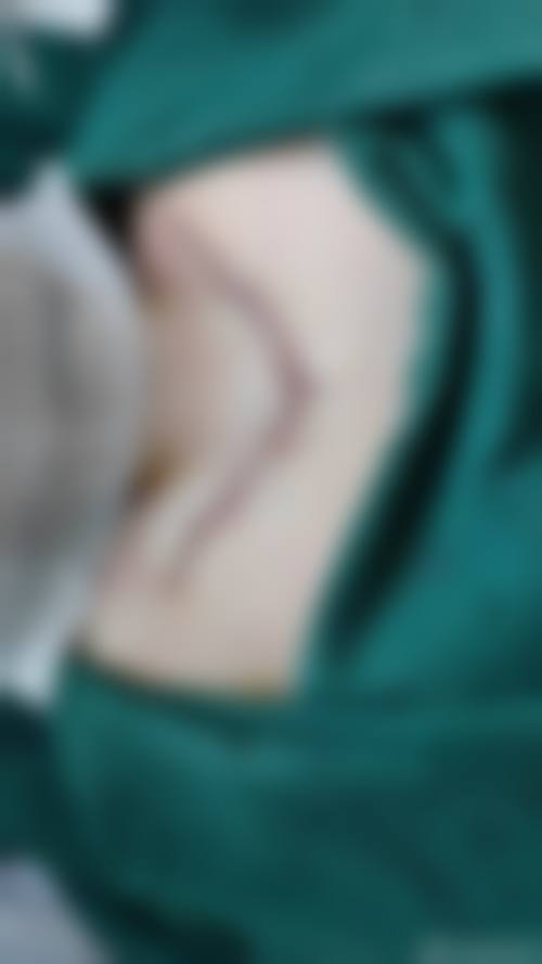 手术修复脸上疤痕