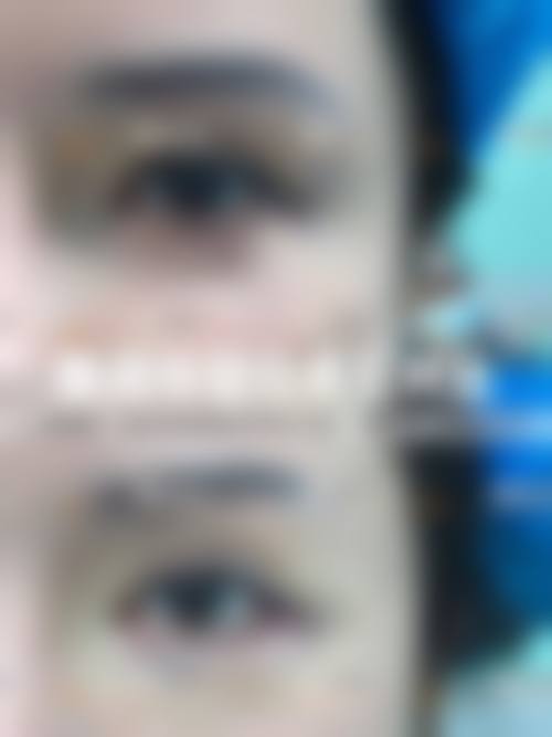 怎么开双眼皮更好：医生评估的重要性