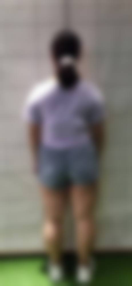 抽脂100毫升脂肪后休息时长