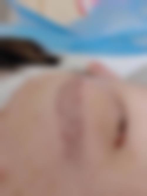 FD四维植发技术可攻克不同类型的脱发！脂溢性、产后脱发等都不怕，移植密度达85%-95%效果自然！ 