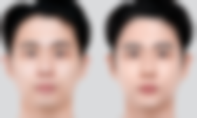 怎么开双眼皮更好：不同人群的选择建议