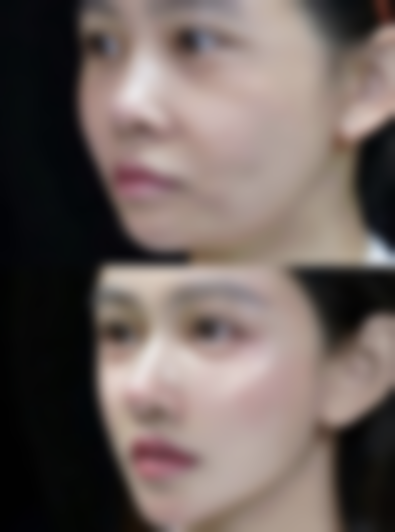 其他影响植发费用的因素