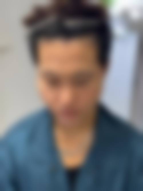 台州大麦植发的植发技术与价格