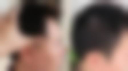 台州大麦植发乘车路线查询：价格区间10 - 60元/单位，多项目低至5000元起！ 