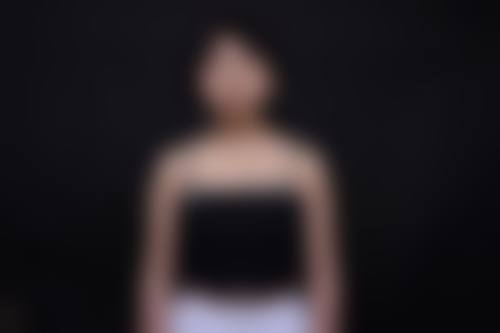 韩式隆胸成效之适用人群