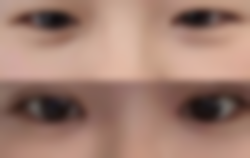 {割了双眼皮什么时候可以洗脸？一般5 - 7天，具体看恢复，拆线次日正常洗更保险！ 