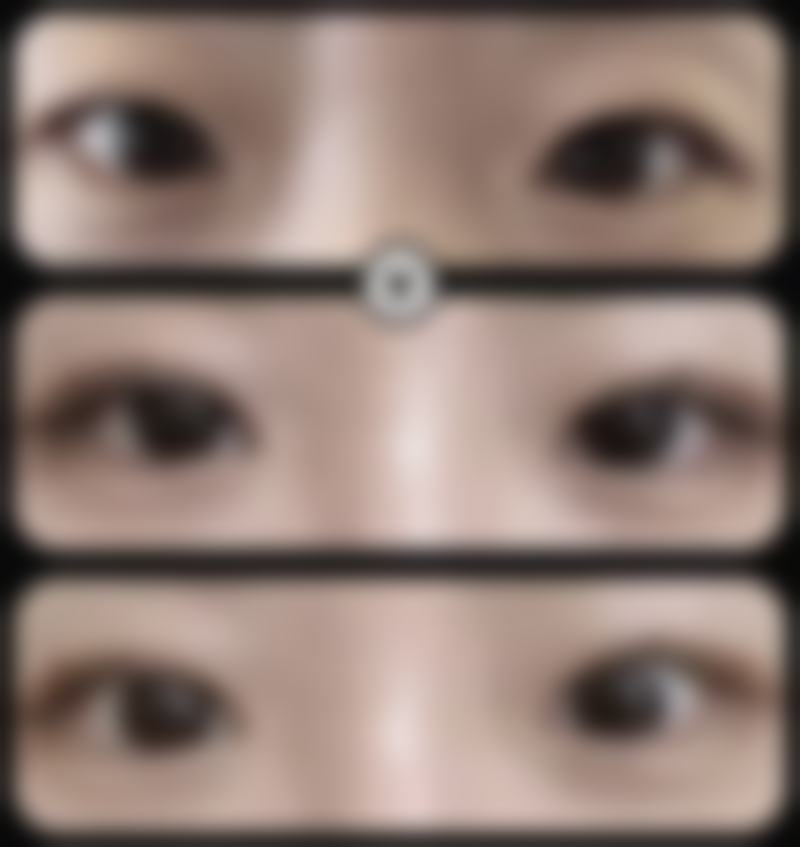 洗脸对双眼皮修复的影响