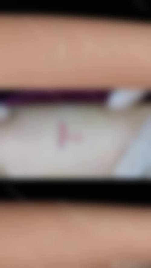 现在有修复疤痕的技术之放射疗法