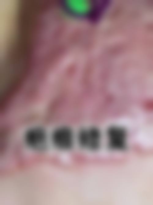 现在有修复疤痕的技术之压力疗法