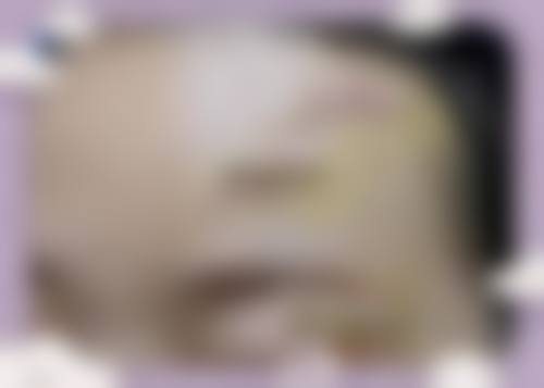 现在有修复疤痕的技术之骨干医生实例