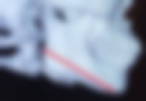 林茂辉医生腹壁成形术实例成效