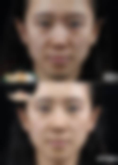 {隆鼻全麻多久能醒？通常手术结束后几分钟到一小时内，30 分钟内清醒较常见 