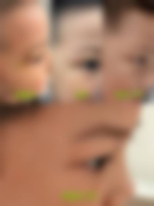 三、手术治疗去除疤痕疙瘩成效如何？