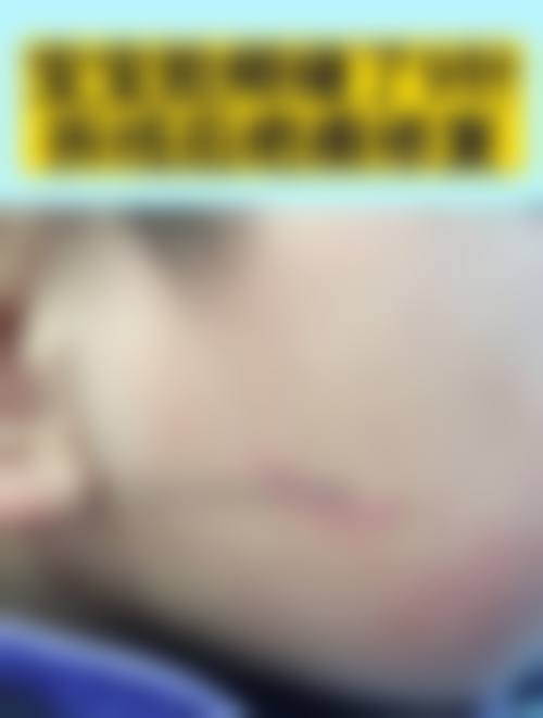 五、放射疗法能有效去除疤痕疙瘩吗？适合哪些人？