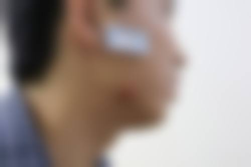 六、压力治疗对去除疤痕疙瘩有帮助吗？适合谁？