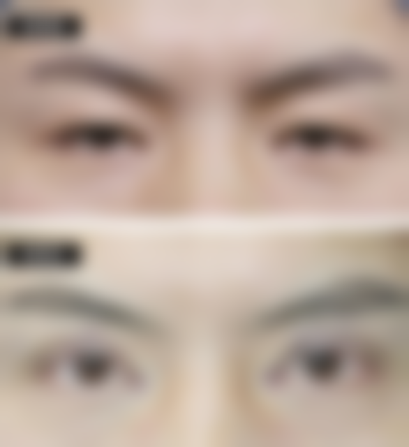 林茂辉医生腹壁成形术经验几何