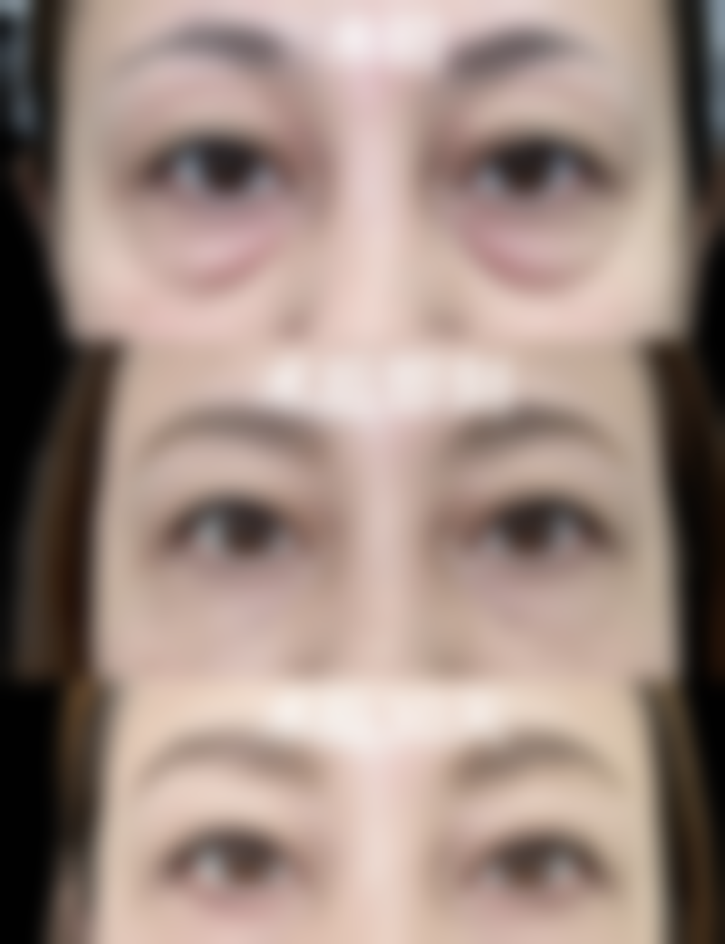 三、肉毒素：动态皱纹与眼袋的改善利器