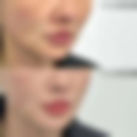 {耳软骨隆鼻要住院吗？一般不用，术后观察1 - 2小时，做好护理即可离院 