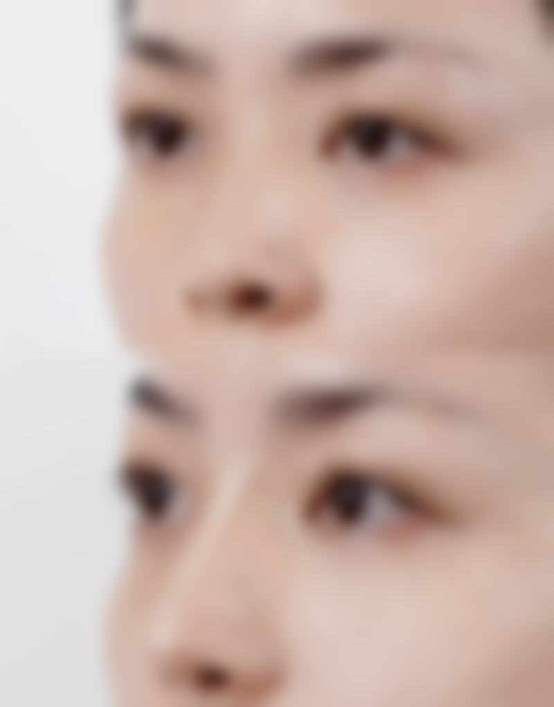 耳软骨隆鼻是否住院的一般情况