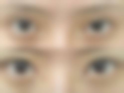 五、黎星医生取生长因子的费用是多少
