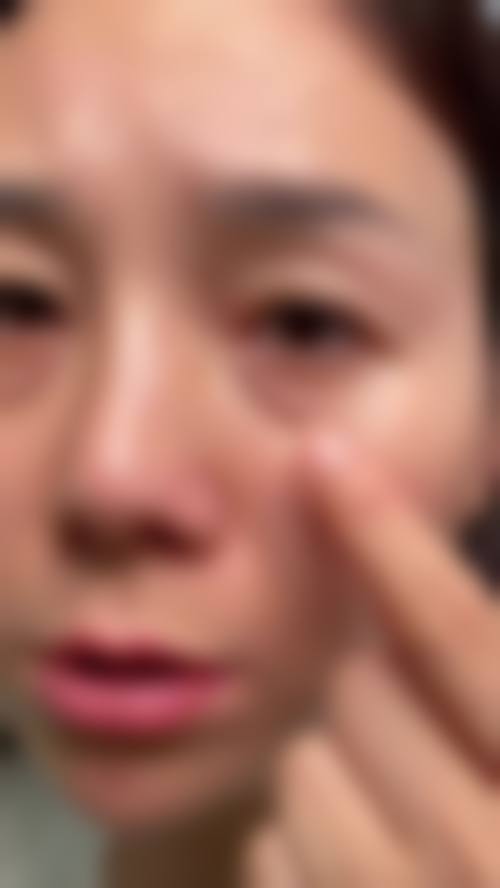 {眼袋手术疤痕增生多久恢复？一般3 - 6个月可软化减轻，特殊情况需及时就医治疗！ 