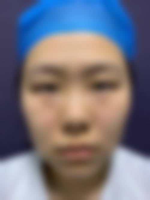 {割的双眼皮多久才会看着自然一点？一般1 - 6个月，恢复时间与手术方式和个人体质有关