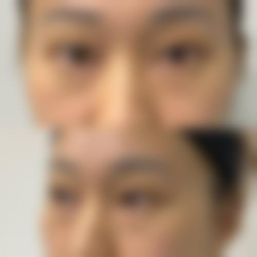 不同类型眼袋与按摩成效