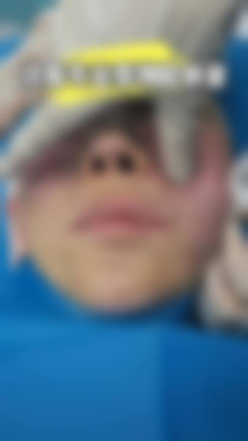 王洪医生取生长因子的破局方案