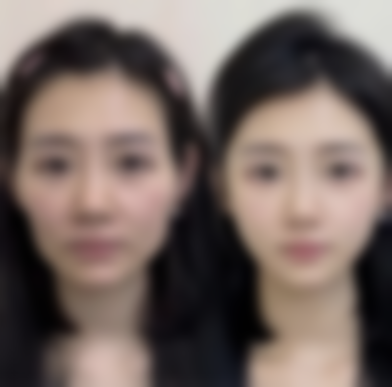 割双眼皮肿胀高峰期与消退过程