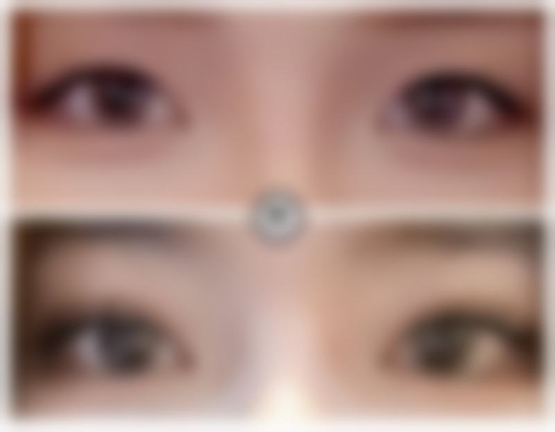 割双眼皮上班时间受个人修复情况影响