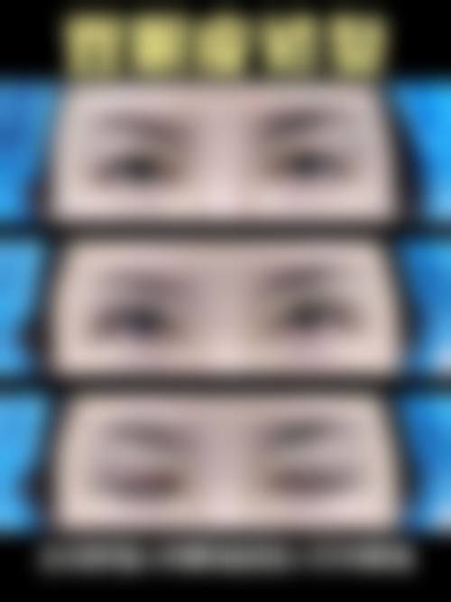 割完双眼皮不同阶段的修复特点