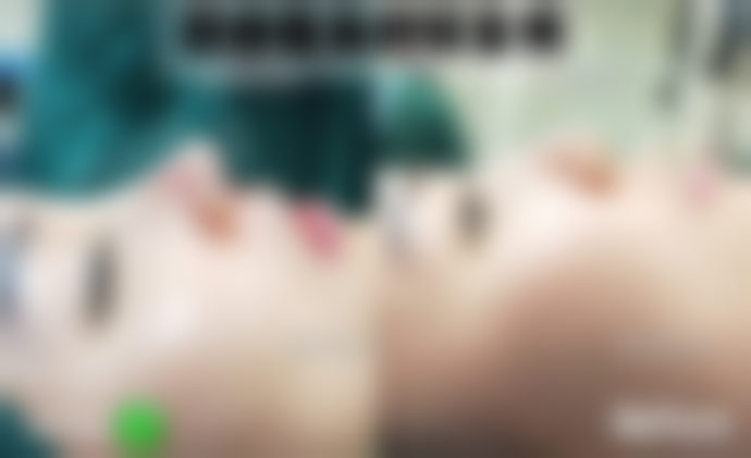 眼周年轻化