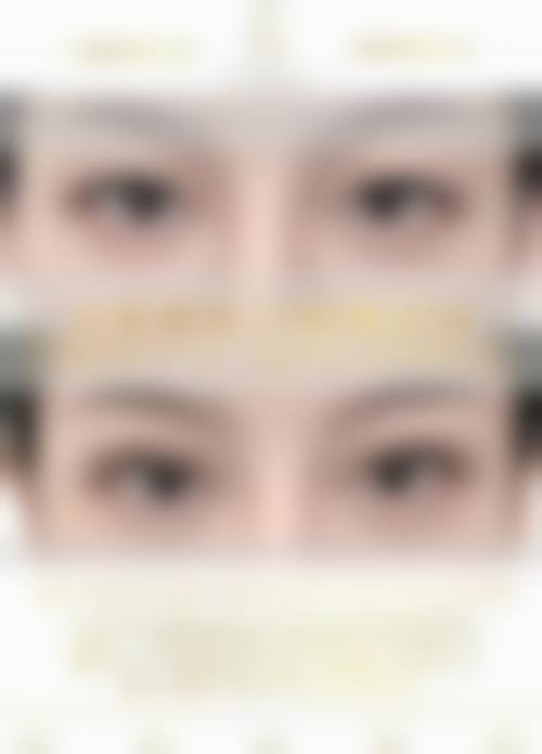 眼皮松弛做双眼皮的风险与注意事项