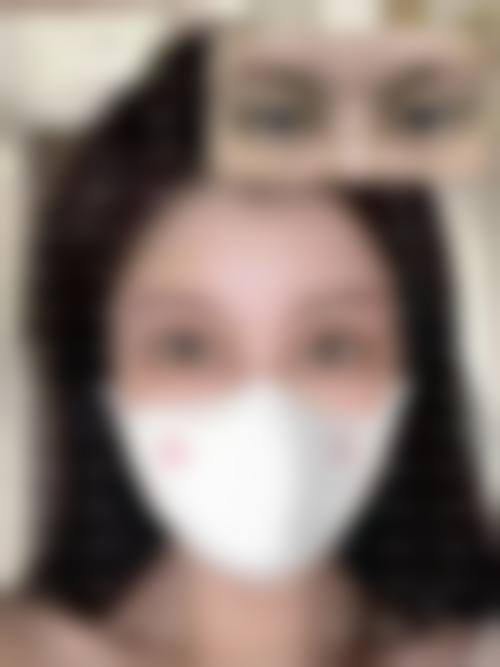 {眼皮松弛做双眼皮能改善吗？切开法或可去除多余皮肤脂肪带来明显改善效果