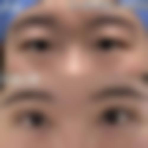 总结：眼皮松弛做双眼皮能否改善因人而异