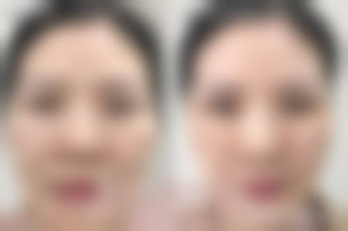 眼皮松弛做双眼皮的影响因素考量