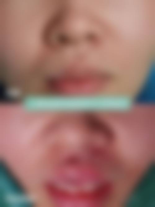割双眼皮年纪大了之后双眼皮形态的改变情况