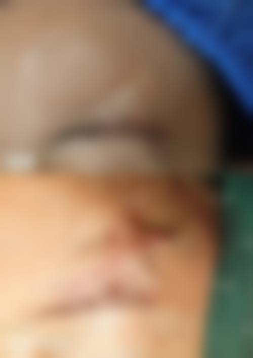 割双眼皮年纪大了之后疤痕的变化情况