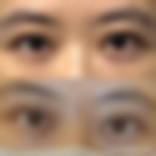 {割双眼皮年纪大了会怎么样？可能出现皮肤松弛、疤痕变化和双眼皮形态改变等情况