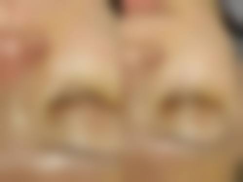 割双眼皮后其他修复注意事项辅助顺利同房